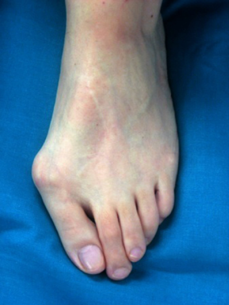 Fusschirurgie Hallux Valgus Fusschirurgie Hallux Valgus
