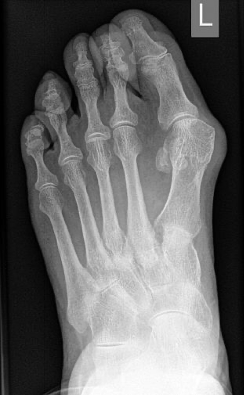 Fusschirurgie Hallux Valgus Fusschirurgie Hallux Valgus