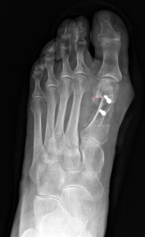 Fusschirurgie Hallux Valgus Fusschirurgie Hallux Valgus
