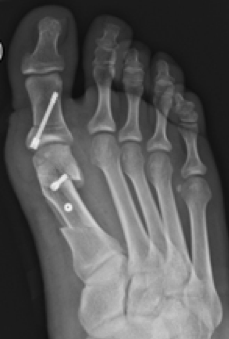 Fusschirurgie Hallux Valgus Fusschirurgie Hallux Valgus